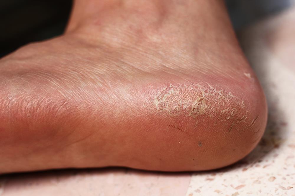 Calluses  Rock Springs, WY 